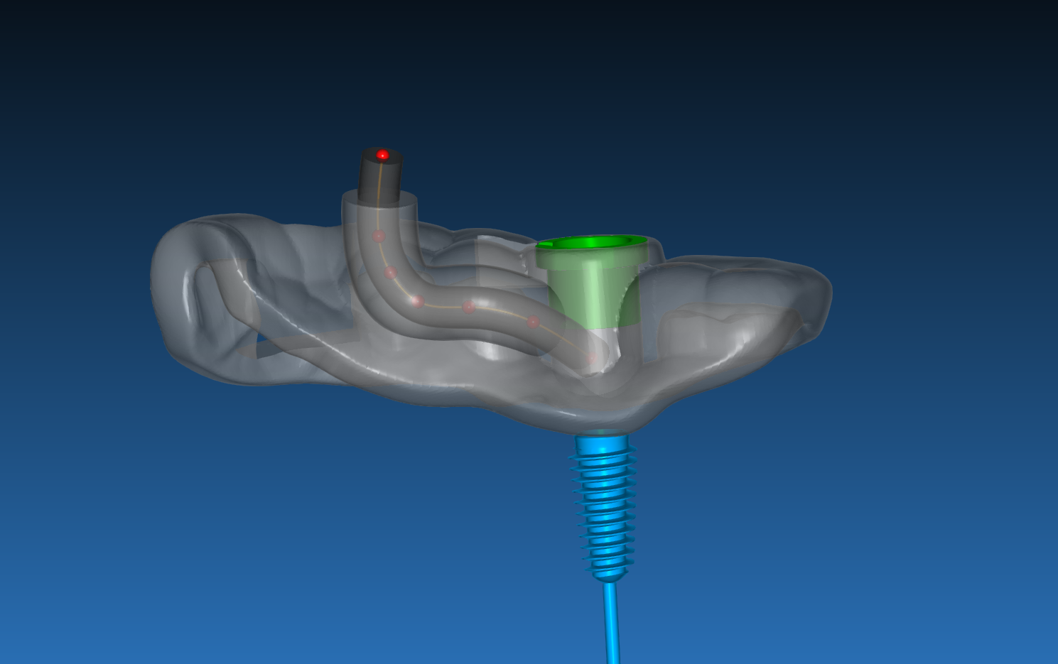 Internal Tube Saline Irrigation in RealGUIDE